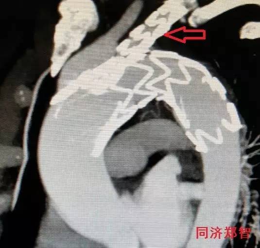 刷三观,主动脉夹层竟还有两个兄弟 刷三观,主动脉夹层竟还有两个兄弟
