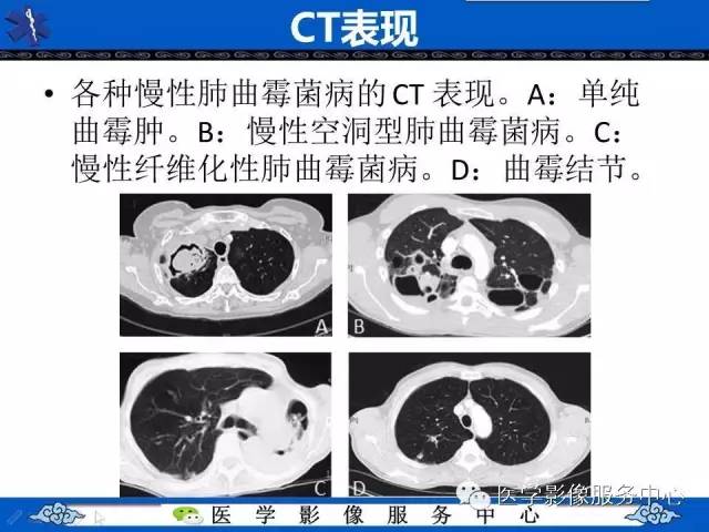 【影像征象】空气新月征