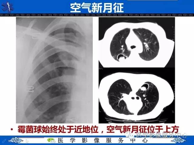 【影像征象】空气新月征