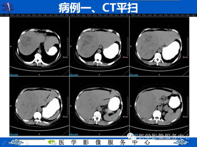 【病例】肝腺瘤2例CT影像表现