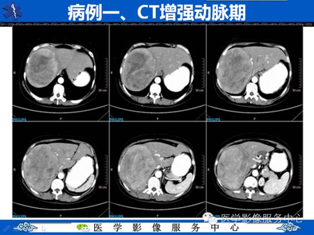 【病例】肝腺瘤2例CT影像表现