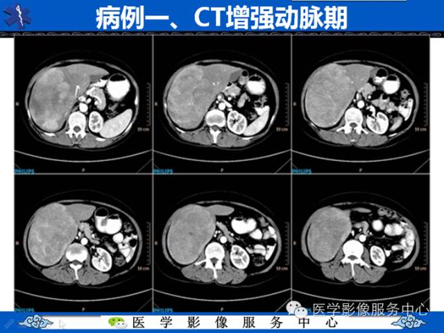 【病例】肝腺瘤2例CT影像表现