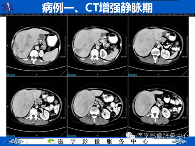 【病例】肝腺瘤2例CT影像表现