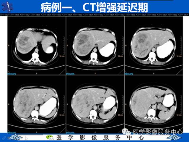 【病例】肝腺瘤2例CT影像表现