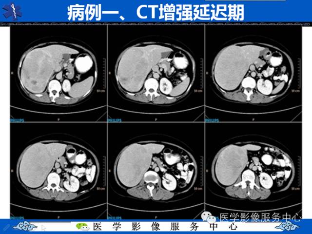 【病例】肝腺瘤2例CT影像表现