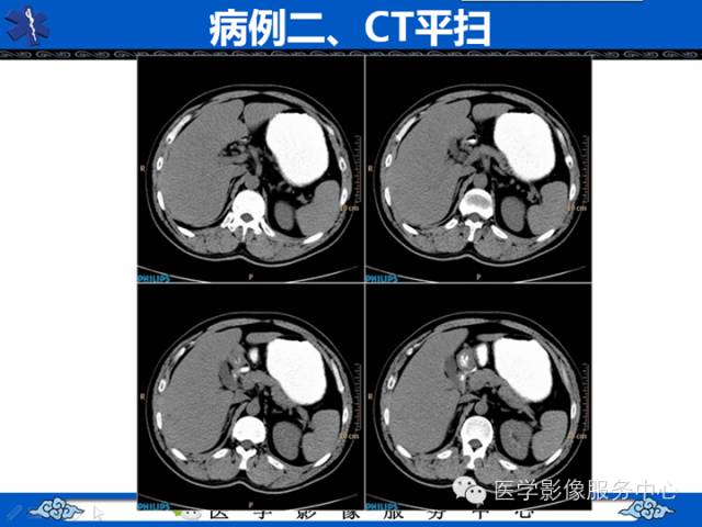 【病例】肝腺瘤2例CT影像表现