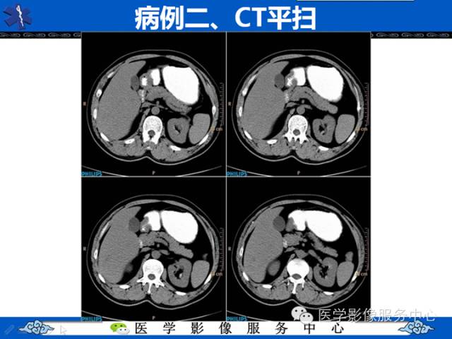 【病例】肝腺瘤2例CT影像表现