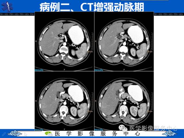 【病例】肝腺瘤2例CT影像表现
