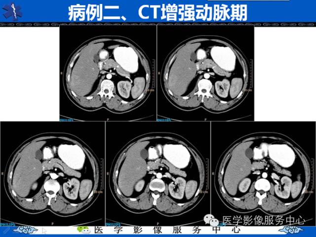 【病例】肝腺瘤2例CT影像表现