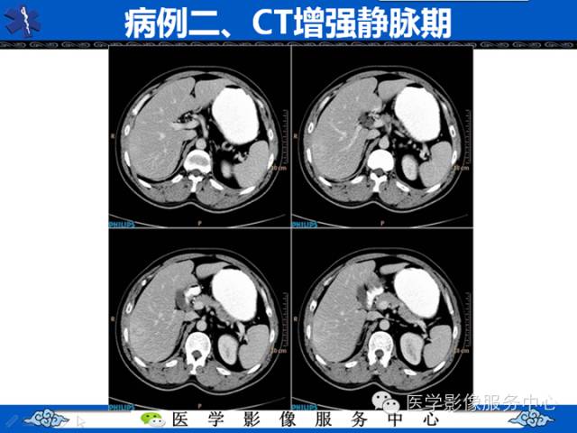 【病例】肝腺瘤2例CT影像表现