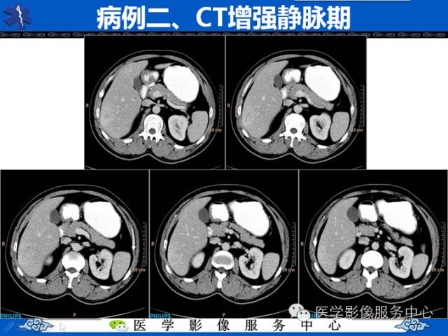 【病例】肝腺瘤2例CT影像表现