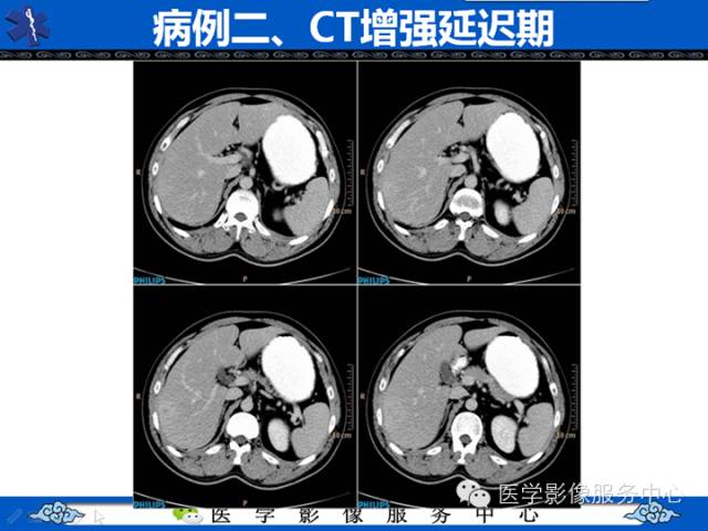 【病例】肝腺瘤2例CT影像表现