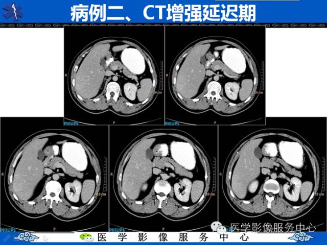 【病例】肝腺瘤2例CT影像表现