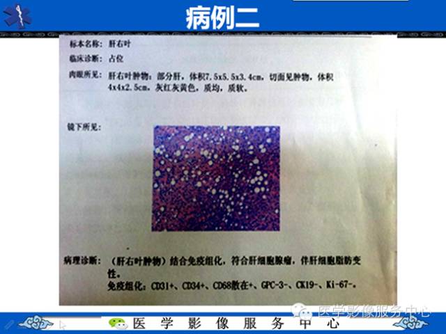 【病例】肝腺瘤2例CT影像表现