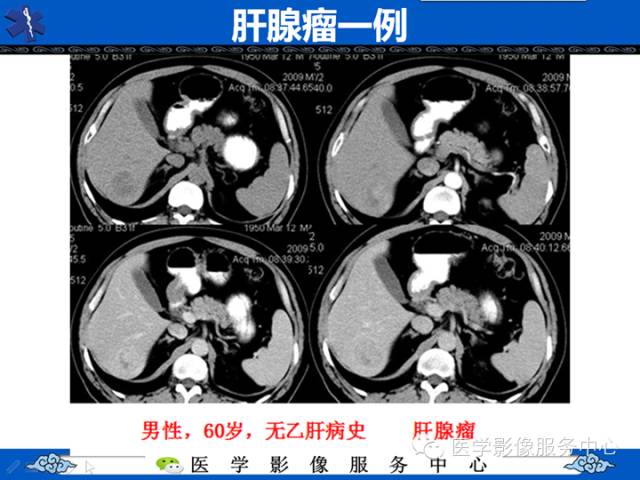 【病例】肝腺瘤2例CT影像表现