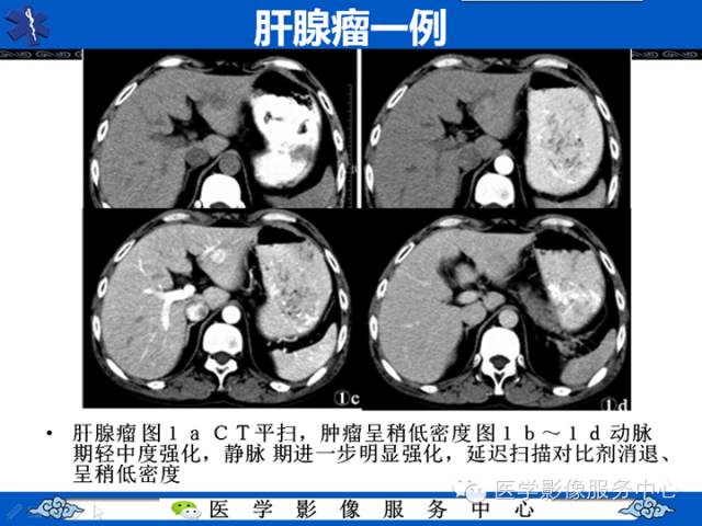 【病例】肝腺瘤2例CT影像表现