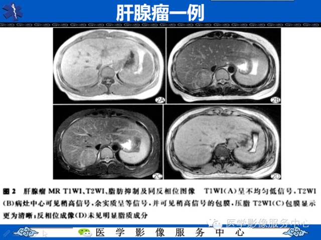 【病例】肝腺瘤2例CT影像表现