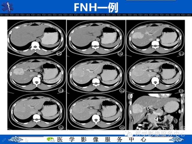 【病例】肝腺瘤2例CT影像表现