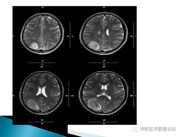 【病例】儿童钙化为主的胶质母细胞瘤1例CT及MR