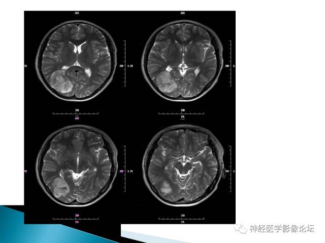 【病例】儿童钙化为主的胶质母细胞瘤1例CT及MR