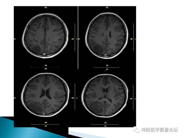 【病例】儿童钙化为主的胶质母细胞瘤1例CT及MR