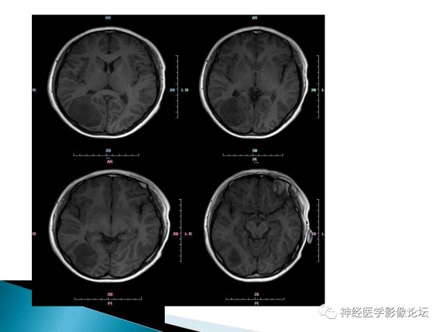 【病例】儿童钙化为主的胶质母细胞瘤1例CT及MR