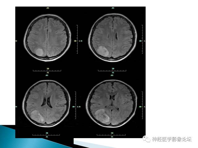 【病例】儿童钙化为主的胶质母细胞瘤1例CT及MR