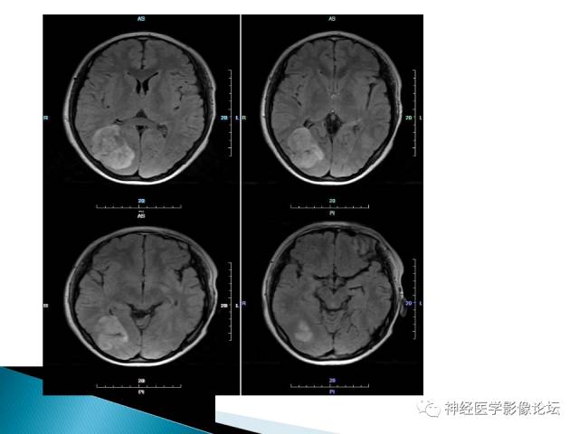 【病例】儿童钙化为主的胶质母细胞瘤1例CT及MR