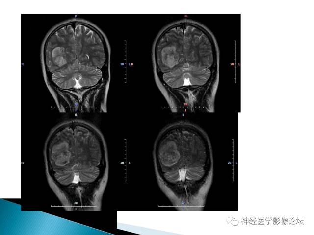 【病例】儿童钙化为主的胶质母细胞瘤1例CT及MR