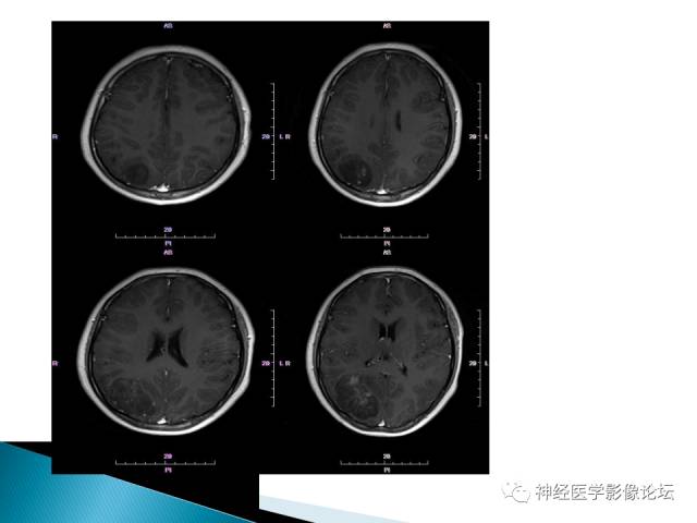 【病例】儿童钙化为主的胶质母细胞瘤1例CT及MR