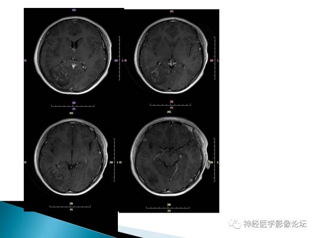 【病例】儿童钙化为主的胶质母细胞瘤1例CT及MR