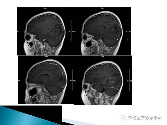【病例】儿童钙化为主的胶质母细胞瘤1例CT及MR