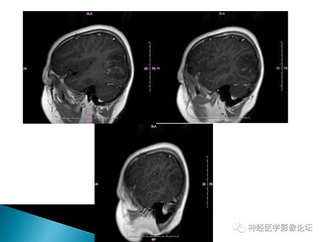 【病例】儿童钙化为主的胶质母细胞瘤1例CT及MR