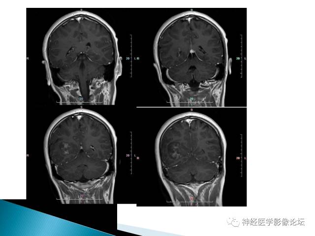 【病例】儿童钙化为主的胶质母细胞瘤1例CT及MR