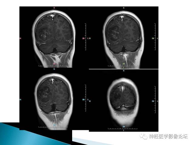【病例】儿童钙化为主的胶质母细胞瘤1例CT及MR