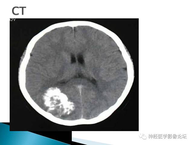 【病例】儿童钙化为主的胶质母细胞瘤1例CT及MR