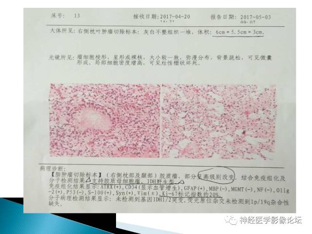 【病例】儿童钙化为主的胶质母细胞瘤1例CT及MR