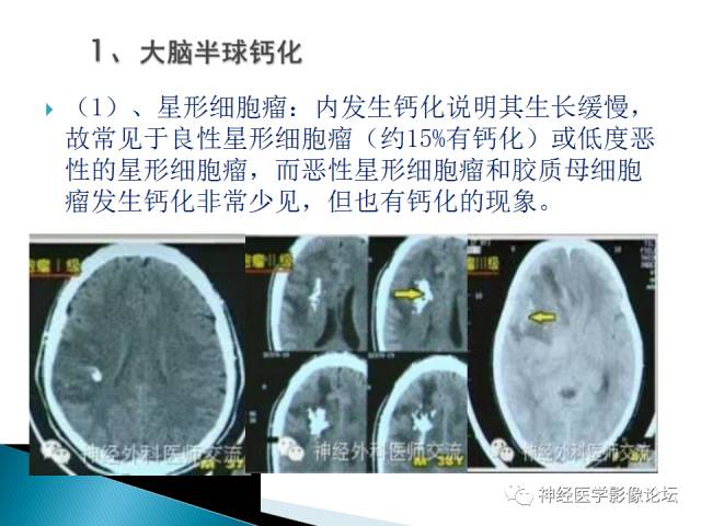 【病例】儿童钙化为主的胶质母细胞瘤1例CT及MR