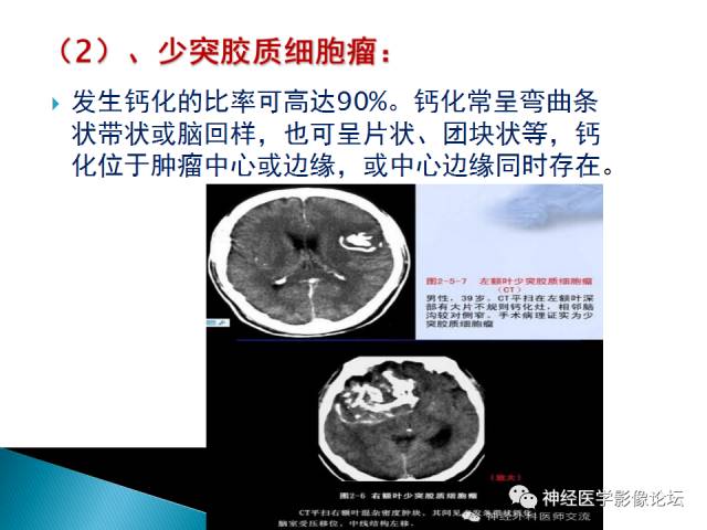 【病例】儿童钙化为主的胶质母细胞瘤1例CT及MR
