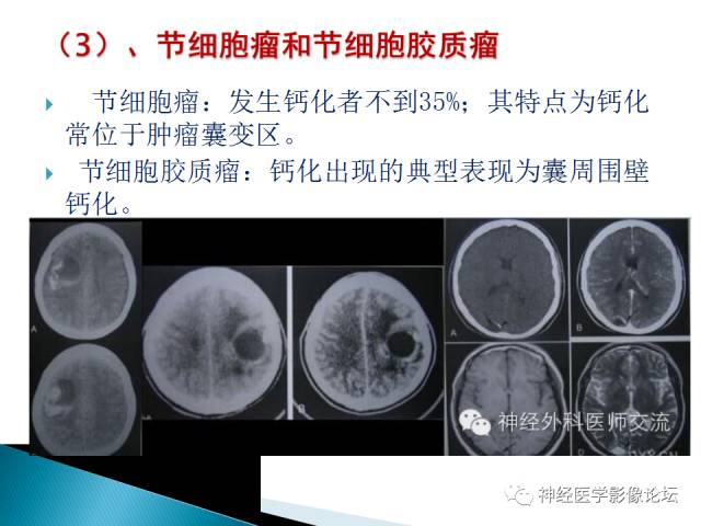 【病例】儿童钙化为主的胶质母细胞瘤1例CT及MR