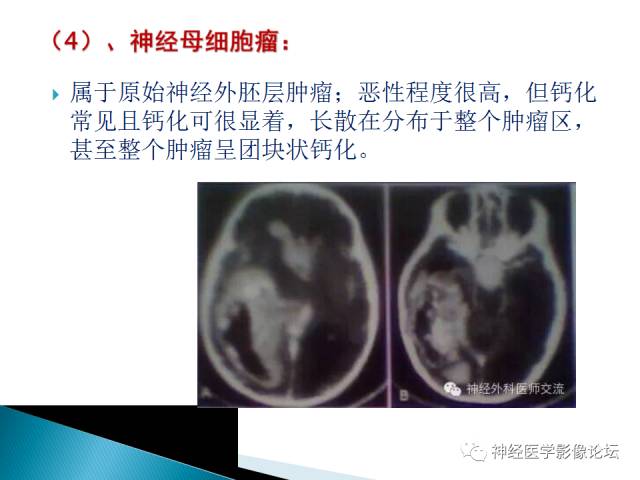 【病例】儿童钙化为主的胶质母细胞瘤1例CT及MR