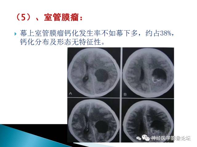 【病例】儿童钙化为主的胶质母细胞瘤1例CT及MR