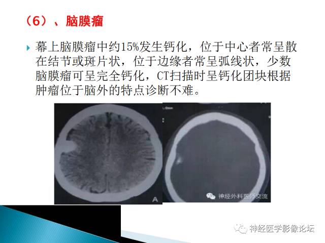 【病例】儿童钙化为主的胶质母细胞瘤1例CT及MR
