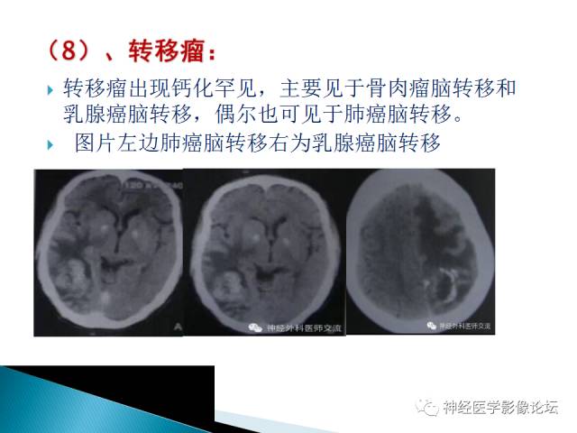 【病例】儿童钙化为主的胶质母细胞瘤1例CT及MR