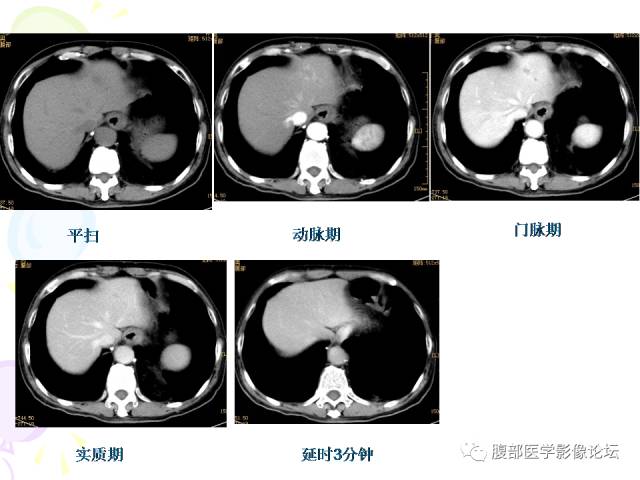 【病例】肝脏多发结核1例CT影像表现 【病例】肝脏多发结核1例CT影像表现