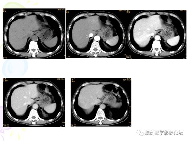 【病例】肝脏多发结核1例CT影像表现 【病例】肝脏多发结核1例CT影像表现