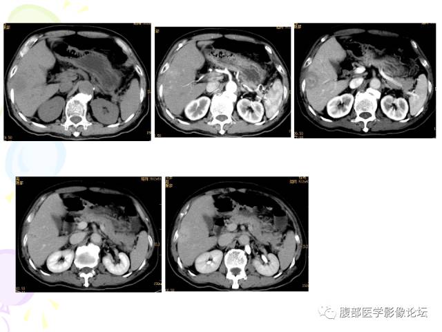 【病例】肝脏多发结核1例CT影像表现 【病例】肝脏多发结核1例CT影像表现