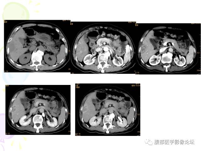 【病例】肝脏多发结核1例CT影像表现 【病例】肝脏多发结核1例CT影像表现