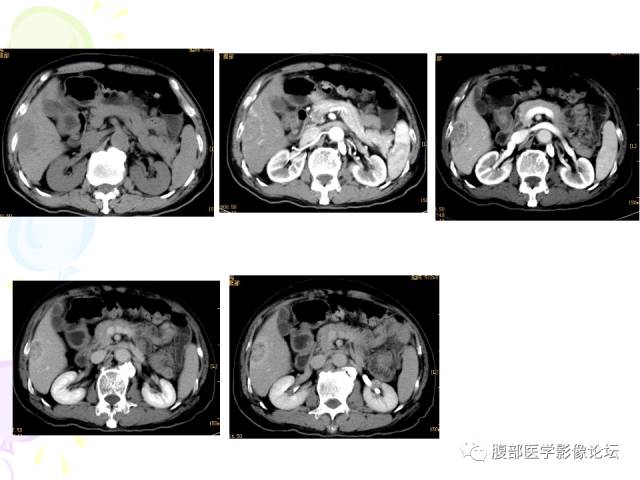 【病例】肝脏多发结核1例CT影像表现 【病例】肝脏多发结核1例CT影像表现