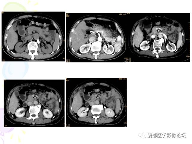 【病例】肝脏多发结核1例CT影像表现 【病例】肝脏多发结核1例CT影像表现